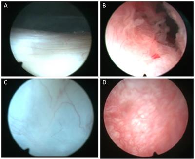 Synovial Tissue Biopsy Research